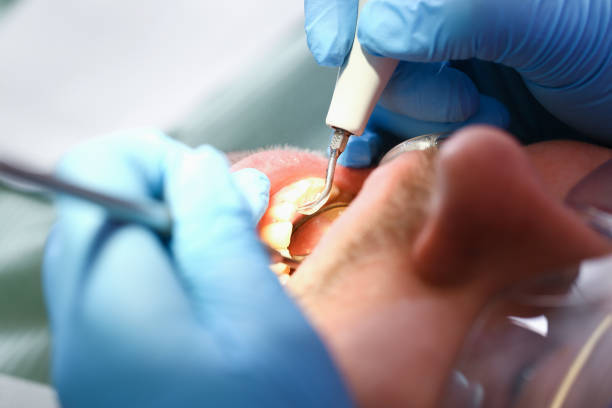 Best Dental Abscess Treatment in Littlerock, CA